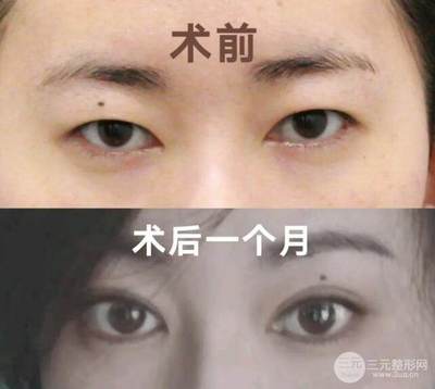 美莱做的双眼皮好吗