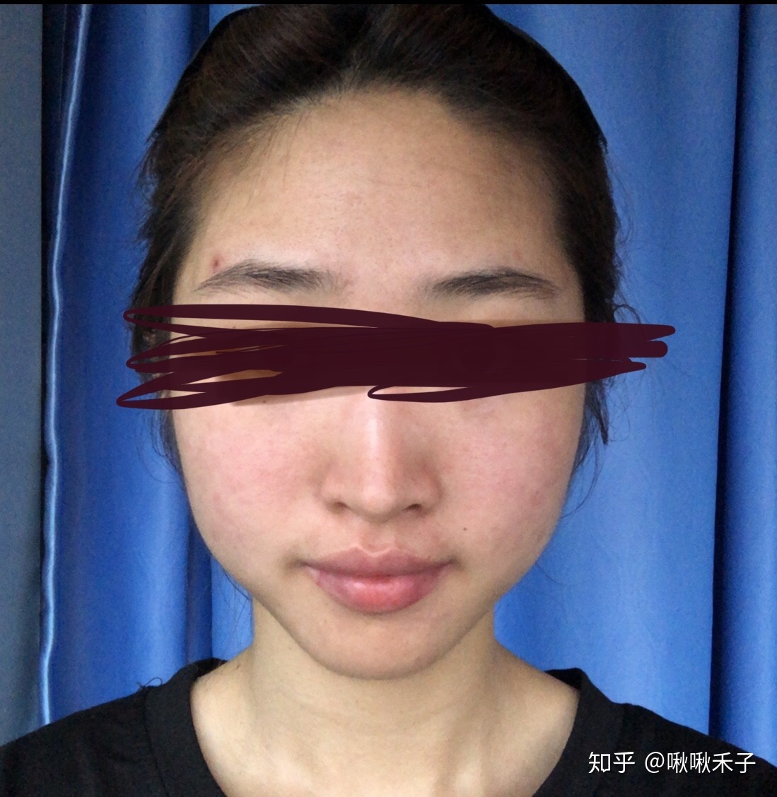 额头痘痘肿了怎么办啊