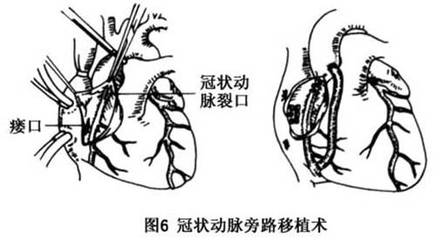 冠状动脉瘘怎么治疗