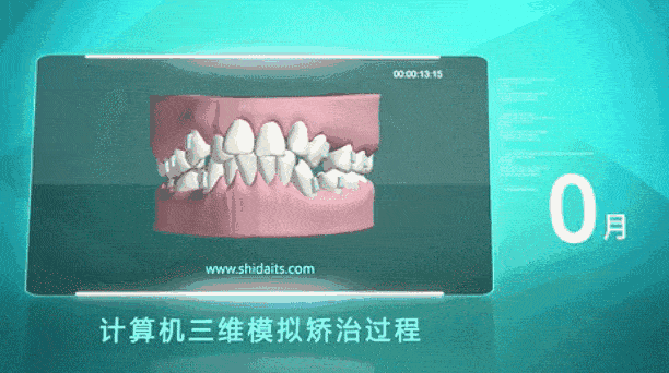 27牙齿还能矫正嘛