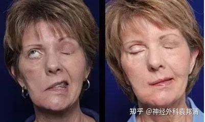眼痉挛怎么治疗