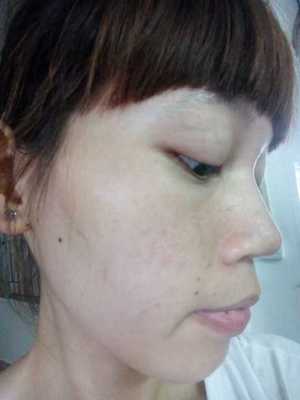 两个星期痘痘好不了