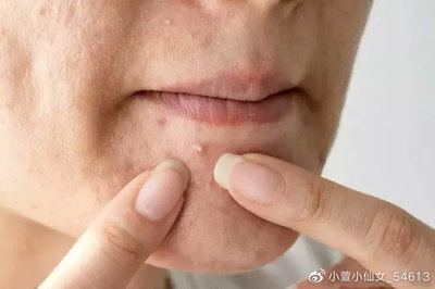 脸上有痘痘不挤会怎样
