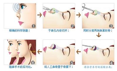 自体软骨隆鼻的缺点
