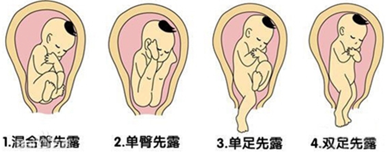 胎儿一直臀位说明宝宝有问题