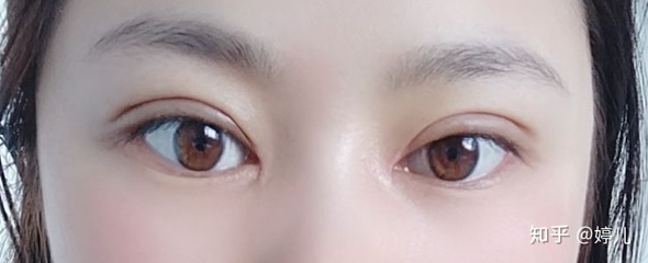 全切双眼皮恢复过程