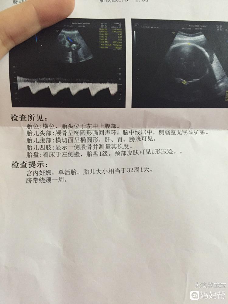 胎儿头位是入盆了吗