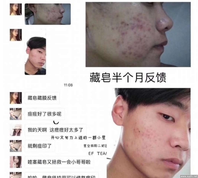 中草药痘痘怎么样