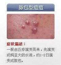 下巴总起囊肿型痘痘