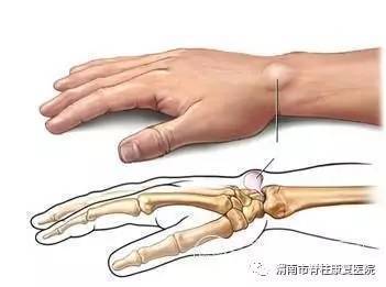 手关节腱鞘炎怎么治疗