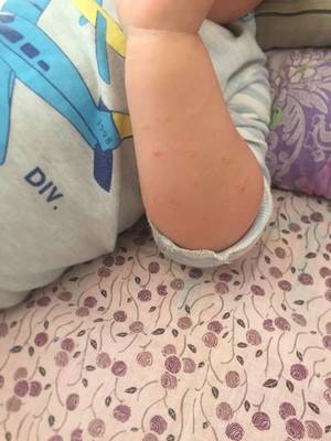 胳膊里有小疙瘩是怎么回事