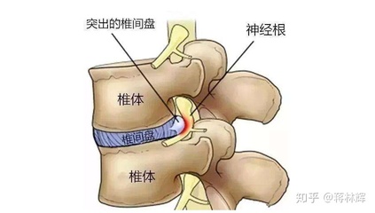 腰间盘突出压迫神经怎么治疗