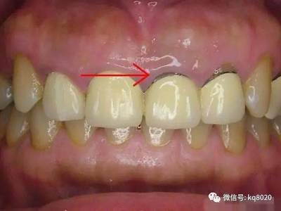 烤瓷牙哪一种好
