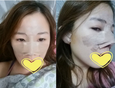 哪里自体隆鼻效果好