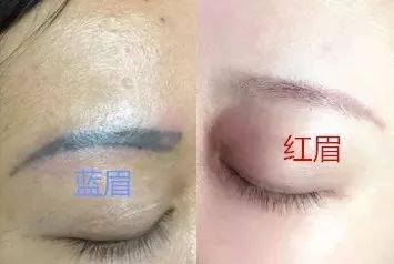半永久眉毛失败案例