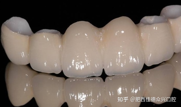 镶一个烤瓷牙多少钱