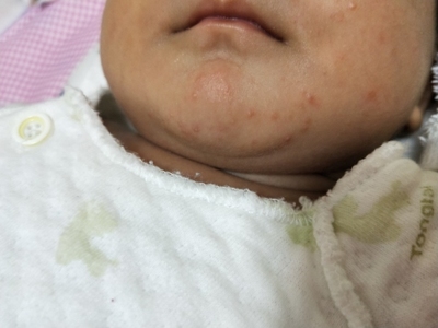 新生儿脸上长痤疮