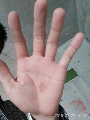 手破皮是怎么回事