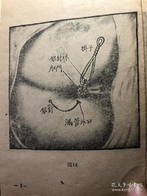 痔漏是怎么回事