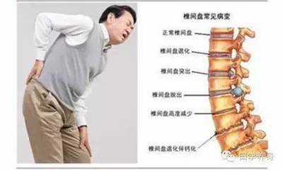 腰间盘突出压迫神经怎么治疗