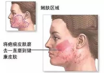 痘痘留下疤痕怎么办