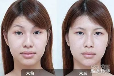 玻尿酸去抬头纹能保持