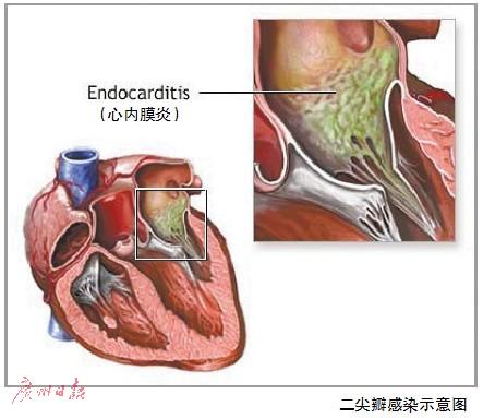 什么是子宫内膜炎