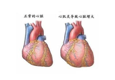 心脏不好会咳嗽吗