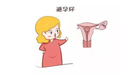 上环为什么会怀孕