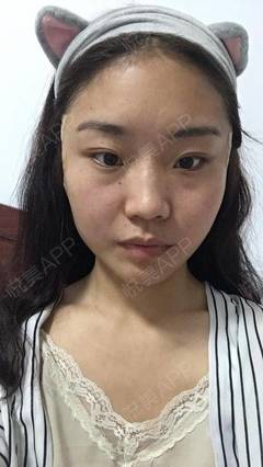 沈阳哪里打瘦脸针正规