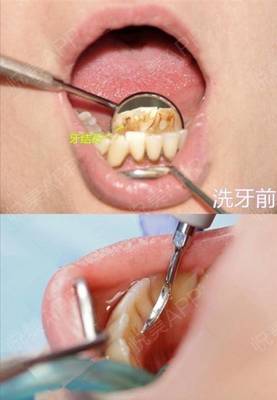 洗牙前要刷牙吗