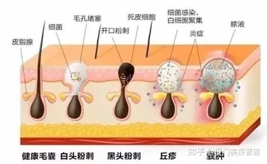 痘痘肌可以光子嫩肤吗