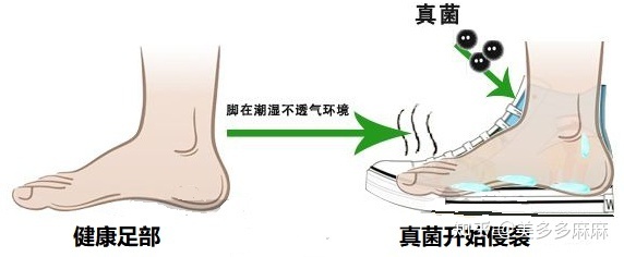 怀孕治脚气的土方法