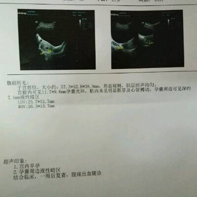 怀孕多久有心管搏动