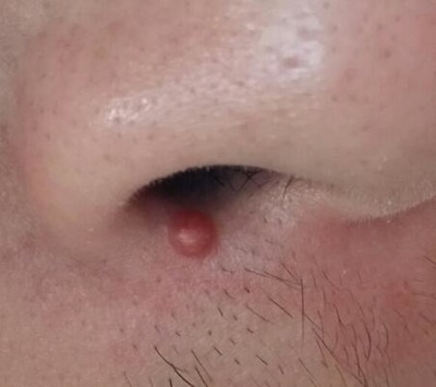 最近鼻子周围长痘痘