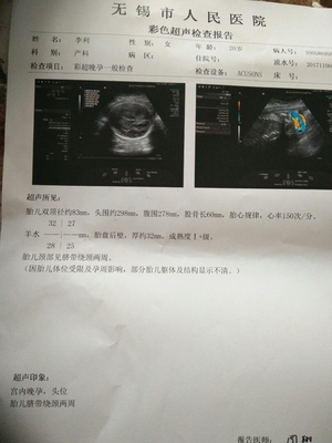 怀孕36周脐带绕颈两周怎么办