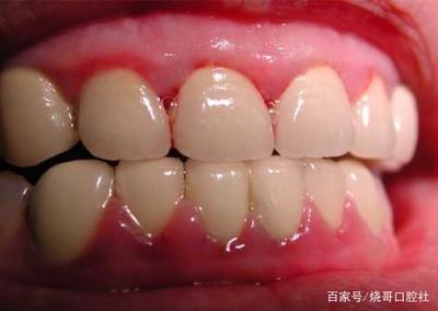 怀孕5个月牙龈肿痛怎么办
