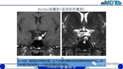 经鼻蝶微创垂体囊肿手术费用多少钱