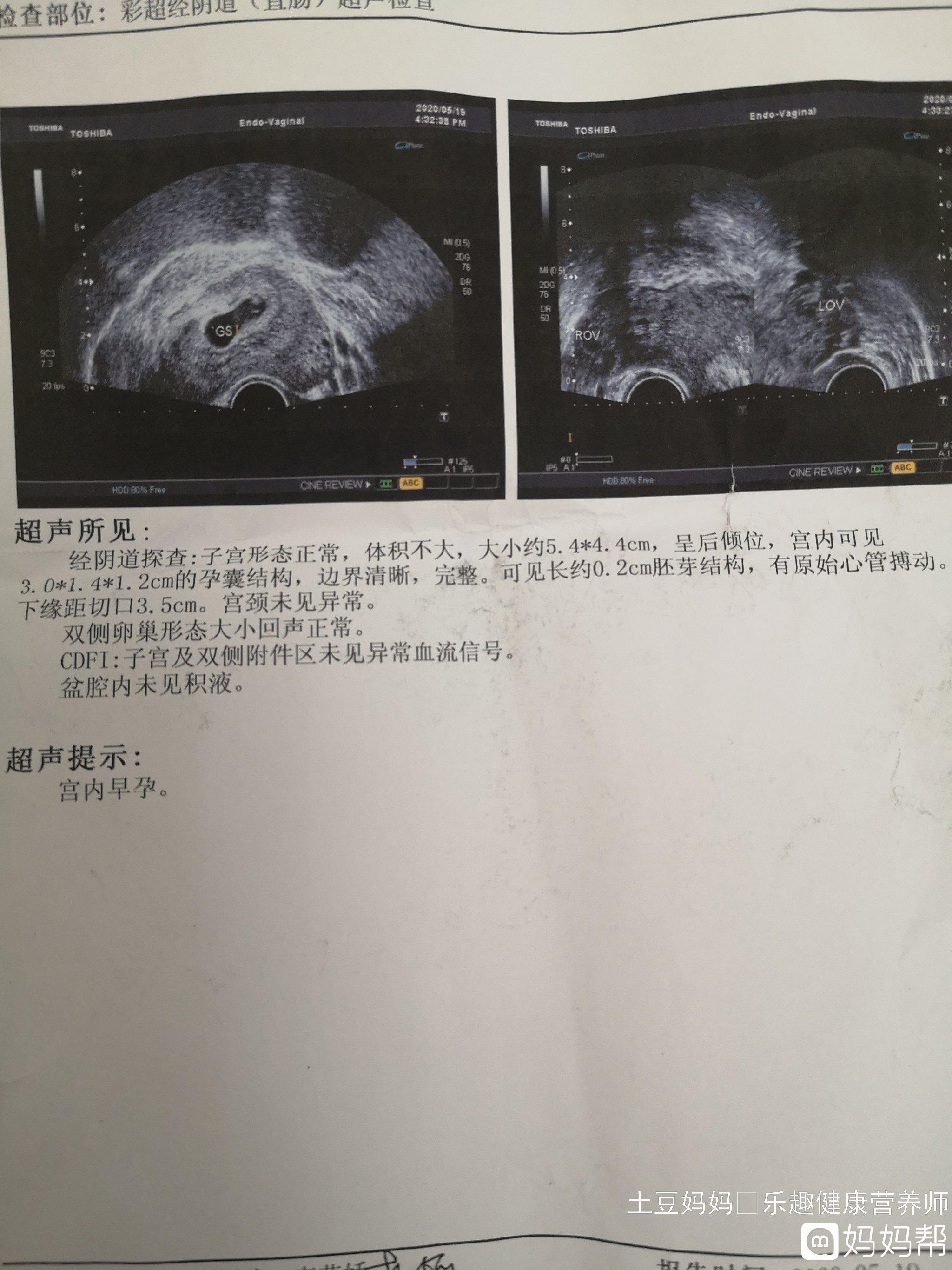 查白带可以查出怀孕吗