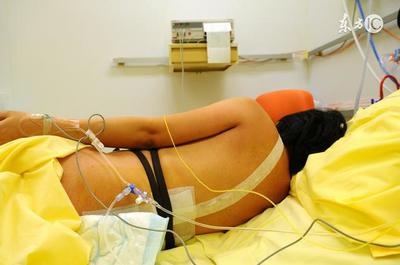 孕妇可以要求剖腹产吗