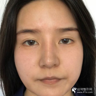 单眼皮双眼皮怎么遗传