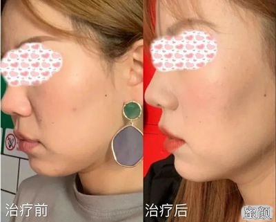 热拉提可以瘦脸吗