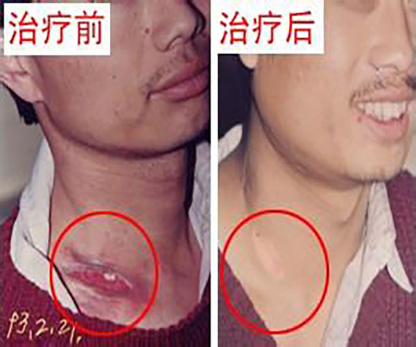 淋巴发炎是怎么回事