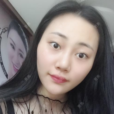 点阵激光治痘痘多少钱一次