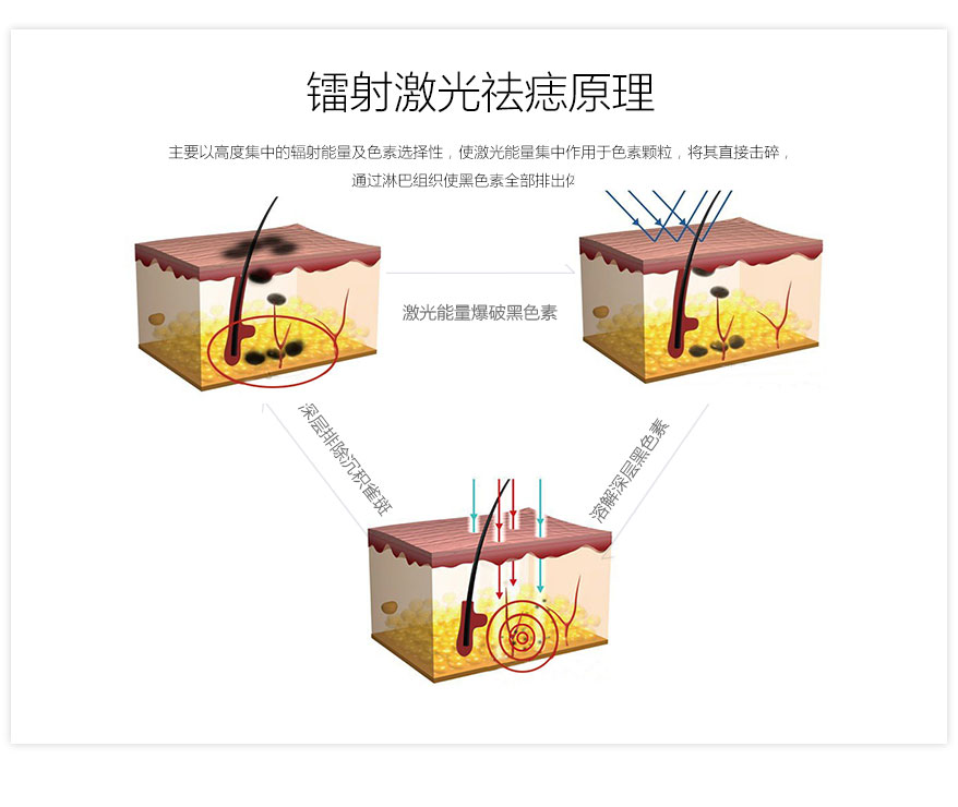 激光祛痣原理