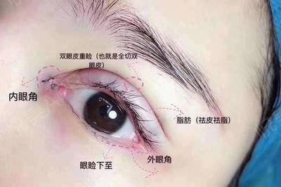 双眼皮切口处发红