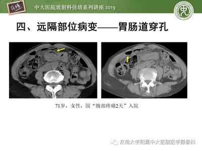 胃右下方疼是怎么回事