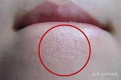 经常长闭口粉刺是什么原因