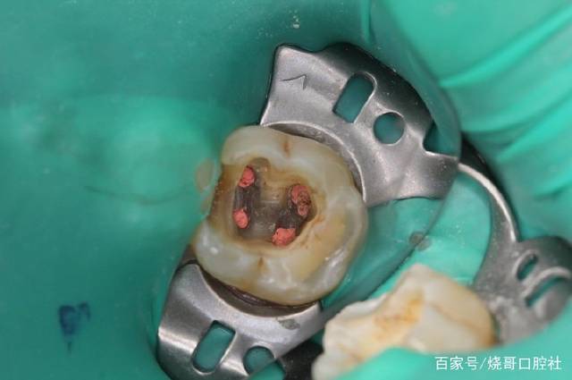 牙齿发炎怎么治疗
