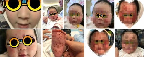 新生儿单纯疱疹病毒感染